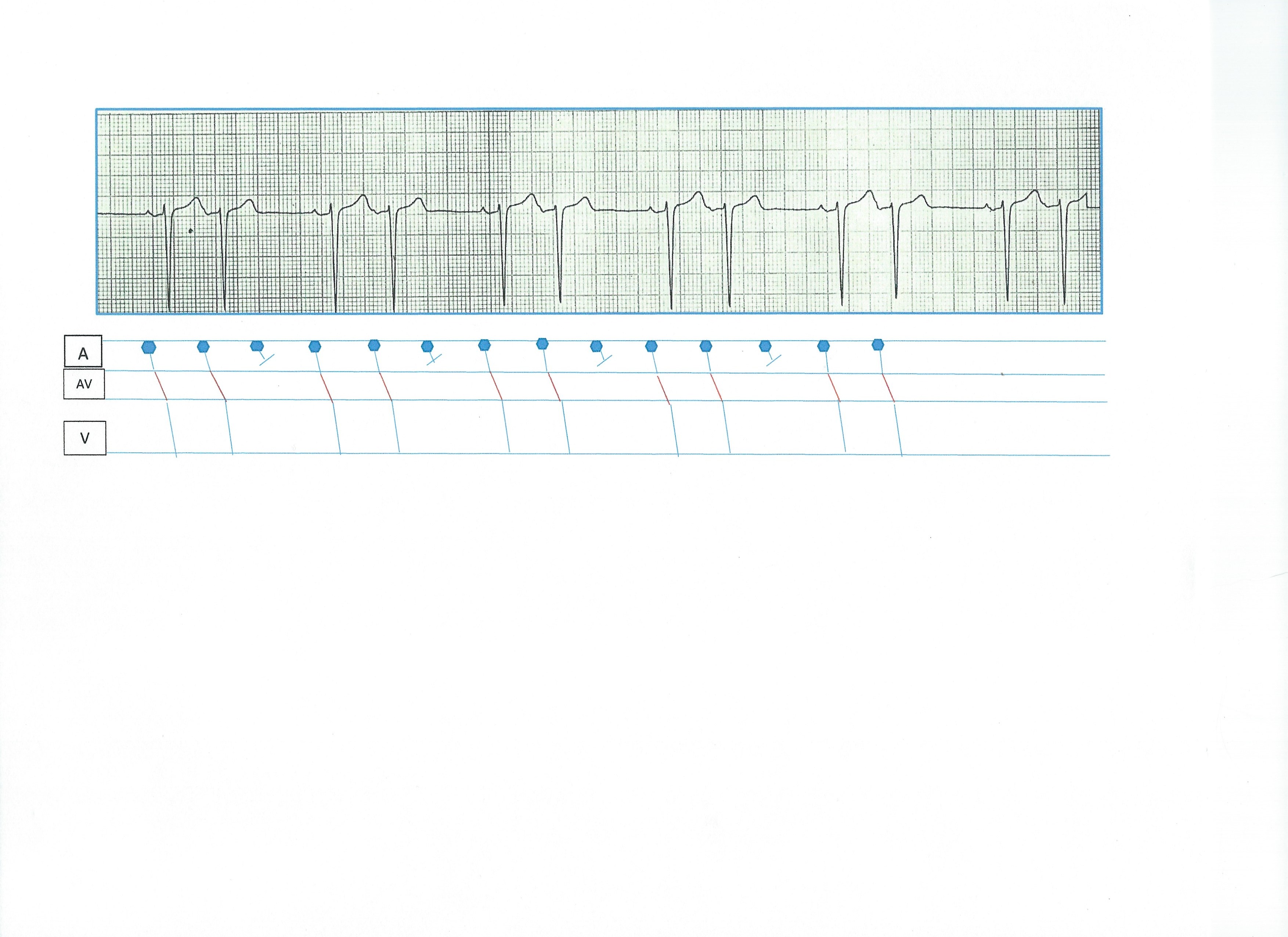 atrial-bigeminy-vs-possible-sino-atrial-exit-block-ecg-guru